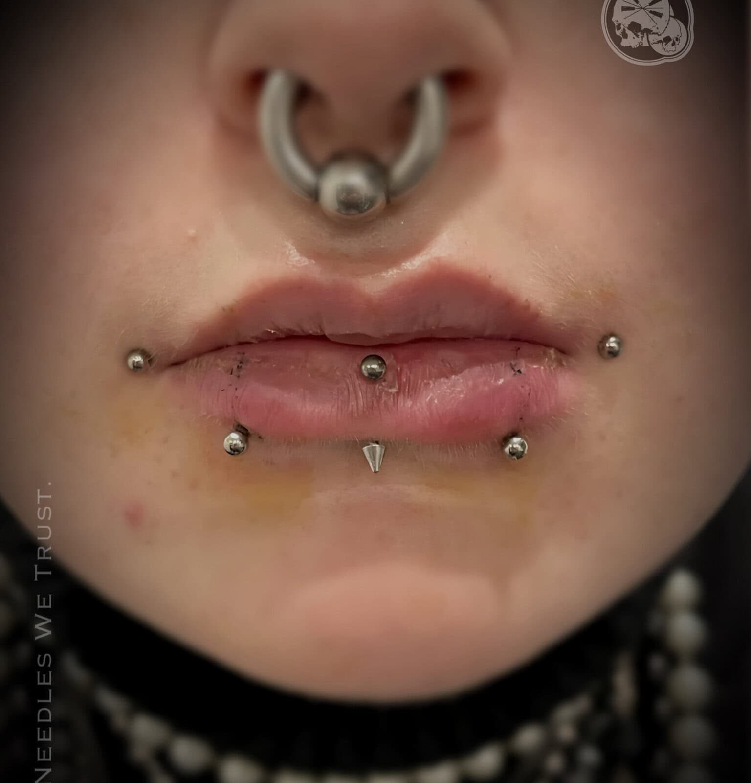 Snake Bites (double labret) — Piercing à Boulogne-sur-Mer (62) | Côte d’Opale — The Needles Factory Piercing Snake Bites (double labret) réalisé à Boulogne-sur-Mer, Pas-de-Calais (Côte d’Opale) — The Needles Factory.